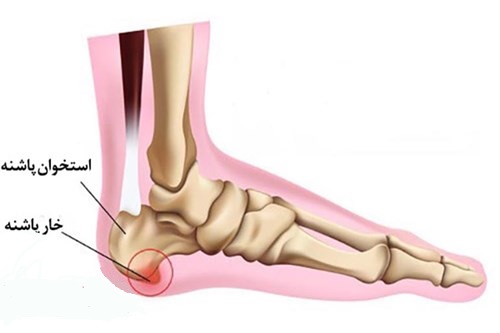 درباره خار پاشنه بیشتر بدانیم